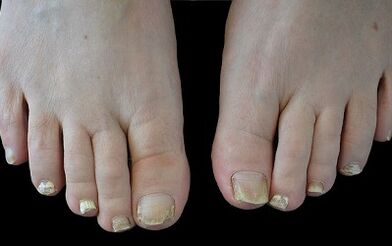 Kako se riješiti gljivica na prstima