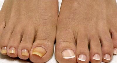 Metode liječenja gljivicama flote